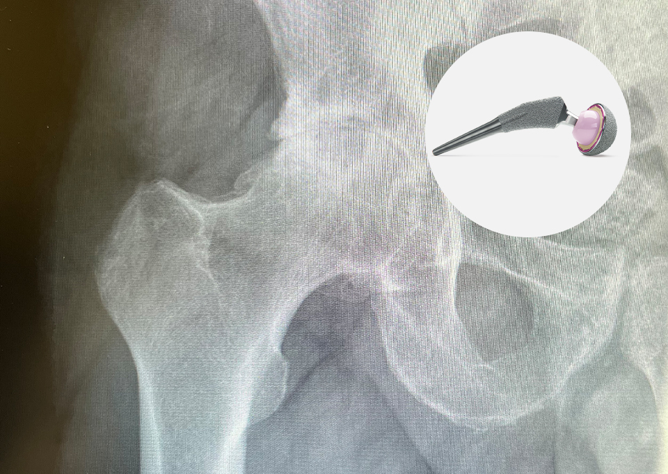 Hip Replacement