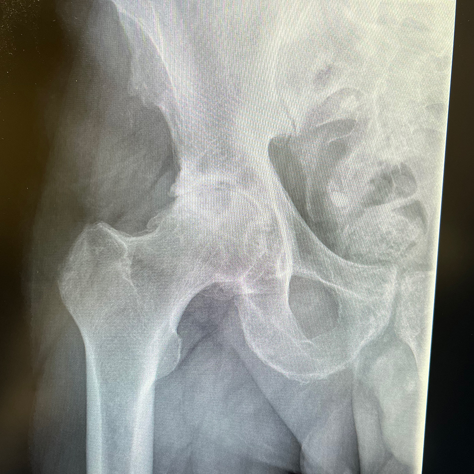 x-ray hip