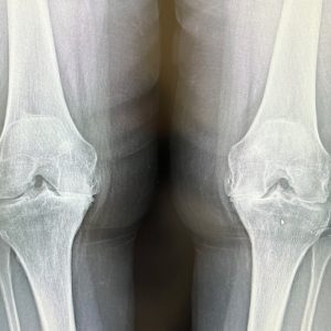 x-ray knee